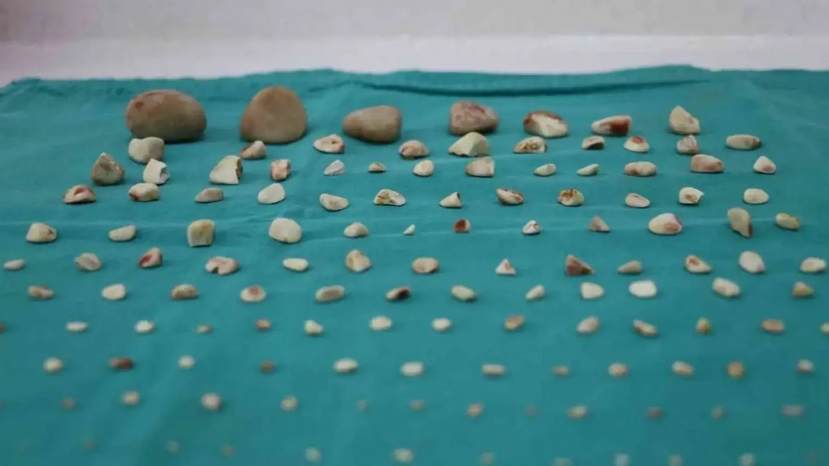 Sivas’ta Zorlu Operasyon: Köpeğin Mesanesinden Yüzlerce Taş Çıkarıldı